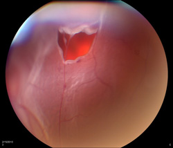 Retinal Detachment Example