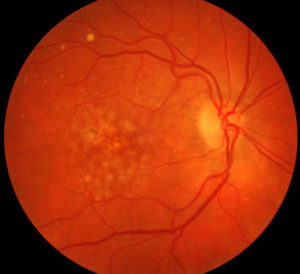 Age-Related Macular Degeneration close-up