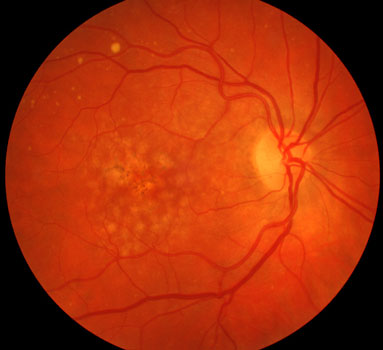 Age-Related Macular Degeneration Example