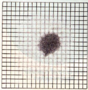 Amsler Grid with Blurry and Black Spots