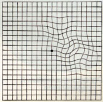 Wavy or cooked lines on an Amsler Grid
