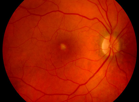 Adult-Onset Macular Dystrophies 