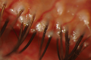 Blepharitis close-up