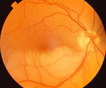  Branch Retinal Artery Occlusion