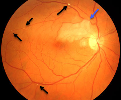 Branched Retinal Artery Occlusions with Multiple Emboli