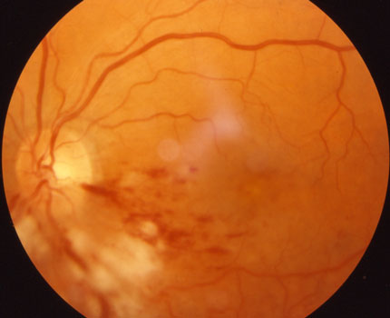 Macular Edema and Hemorrhages Before Laser Surgery