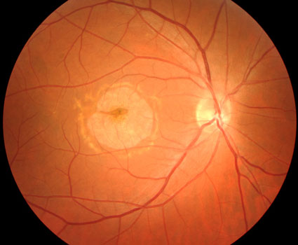 Bullseye Maculopathy Example