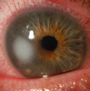 small Corneal Ulcer example