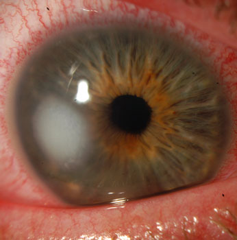 Resolved corneal ulcer