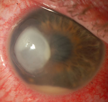 Acute pseudomonas corneal ulcer