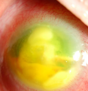 Corneal Ulcer close-up