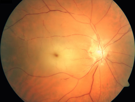 Central Retinal Artery Occlusion Example