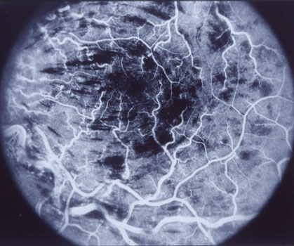 Angiogram of non-ischemic central Retinal Vein Occlusion