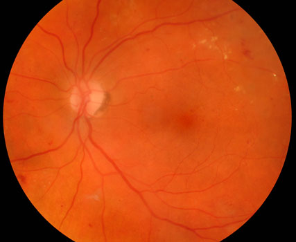Macular Edema Results after Laser Surgery