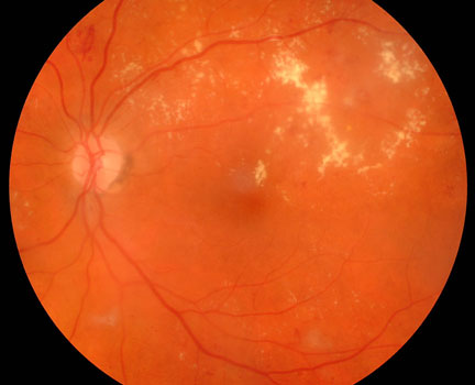 Macular Edema Example with Yellow Lipid Threatening Central Vision