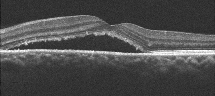CSR with Fluid Below the Macula Example