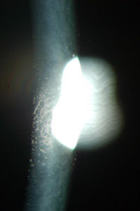 Corneal photograph of the same patient shows numerous tiny brownish guttata.