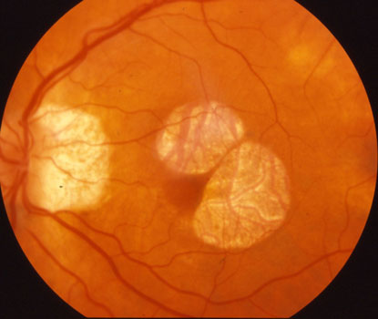 Geographic atrophy just spares the macular center
