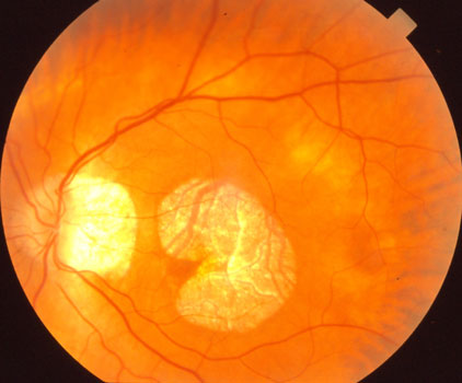 Gradually enlarging Atrophy, causing loss of central vision