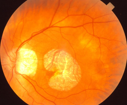 Retinal Detachment Lexington, Retinal Tears Louisville