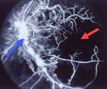 Angiogram of Ischemic Central Retinal Vein Occlusion with Neovascularization