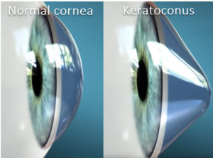 Normal cornea compared to Keratoconus