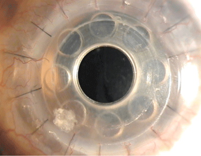 Keratoprosthesis In the Eye