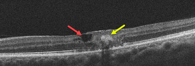 OCT Scan showing Macular Tissue loss