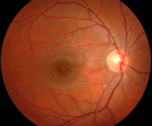 View of a normal macula