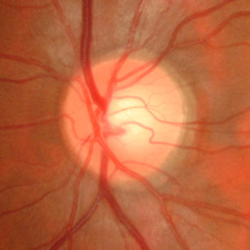Normal Optic Nerve Example