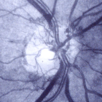Lacy New Blood Vessels (NVD) Covering the Optic Nerve