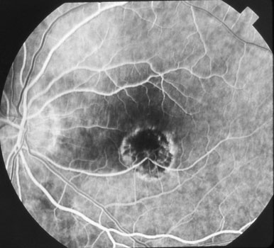 Histoplasmosis Eye Chart