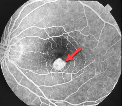 Histoplasmosis Eye Chart