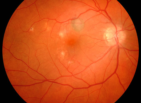 Macular histoplasmosis scarring with CNV