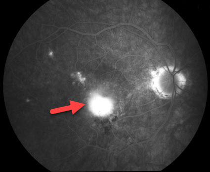 Choroidal Neovascularization Example