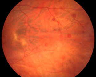 Ocular Ischemia with Midperipheral Hemorrhages
