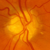 Pseudopapilledema from Optic Nerve Drusen