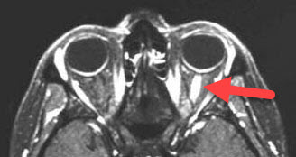 Inflammed Optic Nerve on an MRI Scan