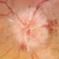 Swollen Optic Nerve from Papilledema