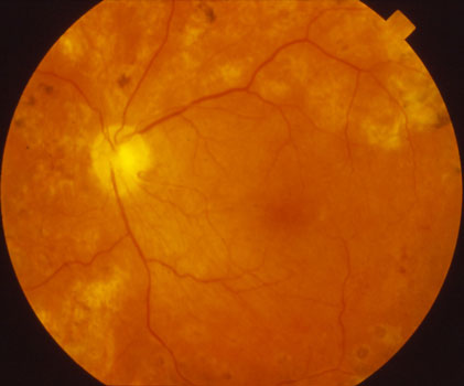  The Retina Reattached Following Vitrectomy Surgery