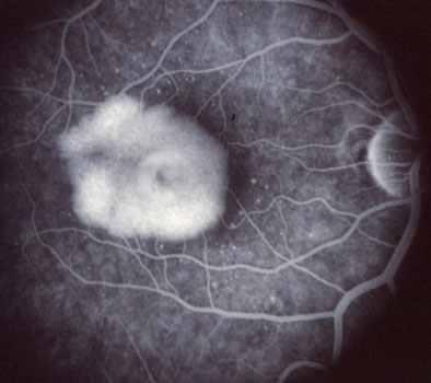Fluorescein Angiogram Showing Retinal Blister
