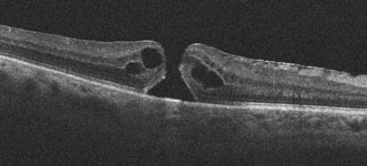 Preop Macular Hole X-Ray