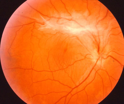 Whitish superior Macular Pucker distorting the Central Macula