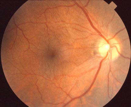 Macula Results after Surgery