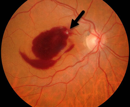 Retinal Arterial Macroaneurysm Example