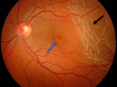 Retinal Detachment Example 