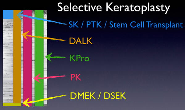 Selective Keratoplasty Diagram