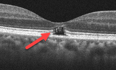 OCT Scan Shows loss of Outer Central Macular Tissue