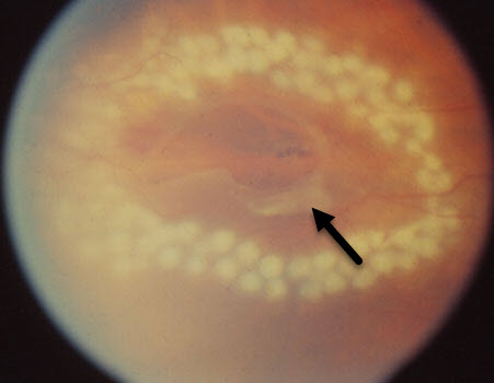 White laser Photocoagulation spots Surround a Retinal Tear