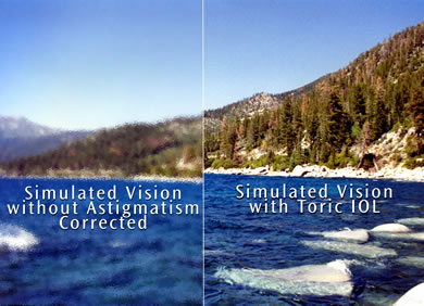 Toric Intraocular lens Vision Results